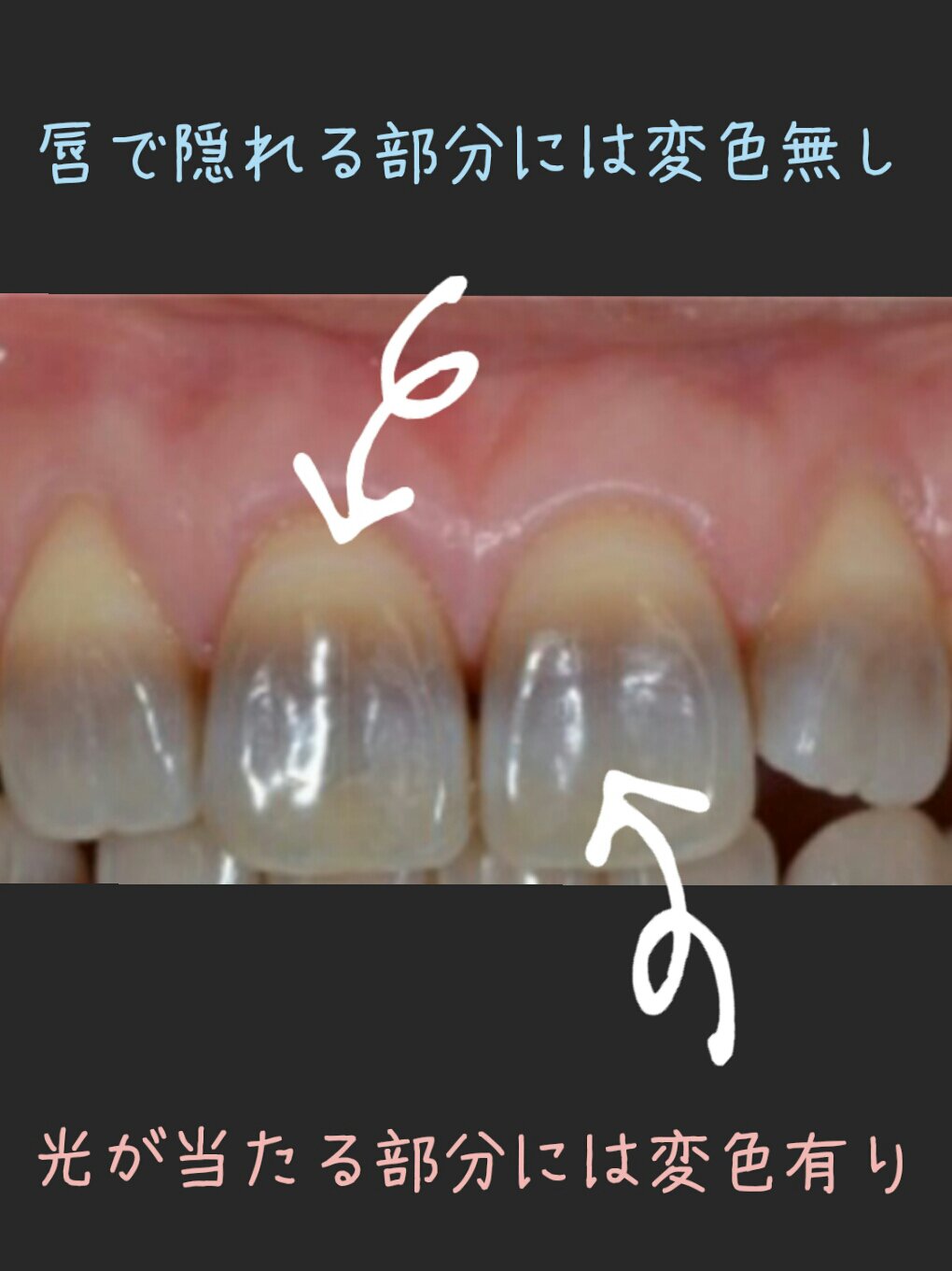 テトラサイクリン歯について