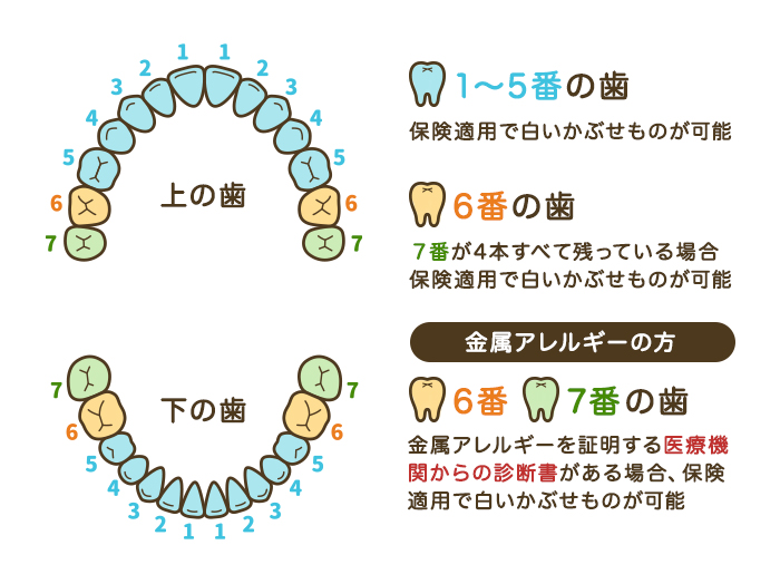 CAD/CAM冠