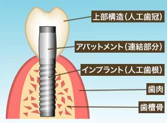 インプラント構造