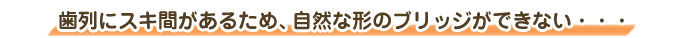 歯列にスキ間があるため、自然な形のブリッジができない・・・
