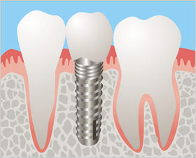 インプラント