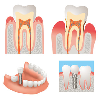 インプラント治療法